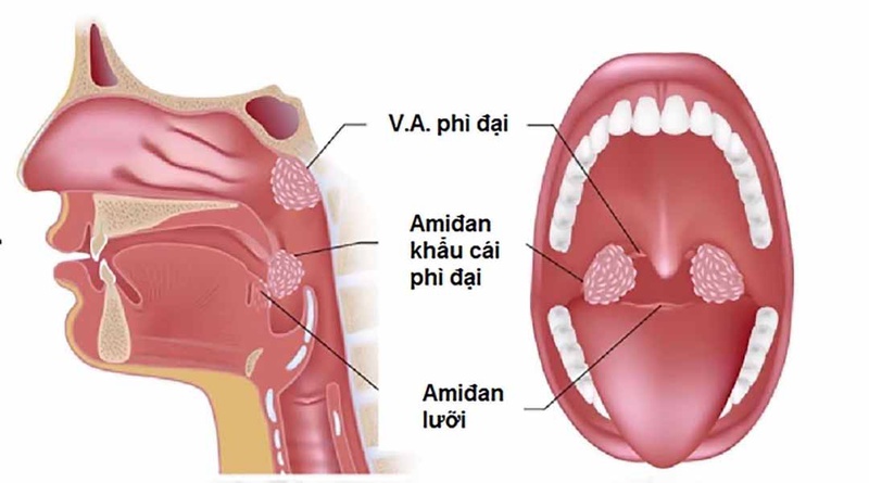 nguyên nhân gây ra viêm tai giữa ở người lớn