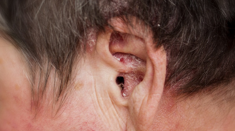 Nguyên nhân viêm tai ngoài mãn tính2