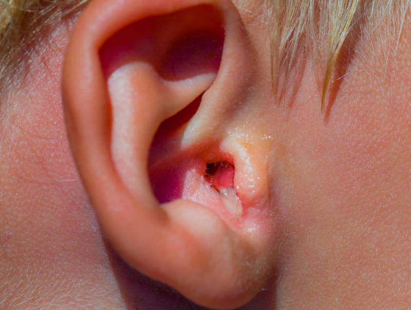 Nguyên nhân viêm tai ngoài mãn tính3