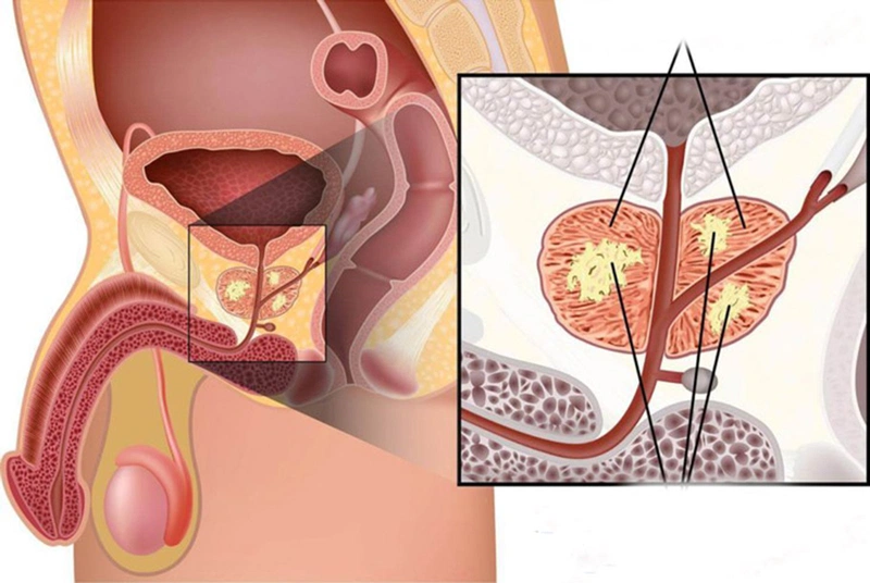 Nguyên nhân vôi hóa tuyến tiền liệt và những điều nên biết 1