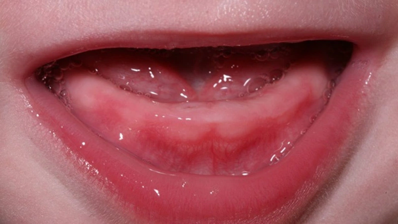 Chồi răng nhỏ xuất hiện dọc theo nướu, trông như những vết sưng nướu nhỏ