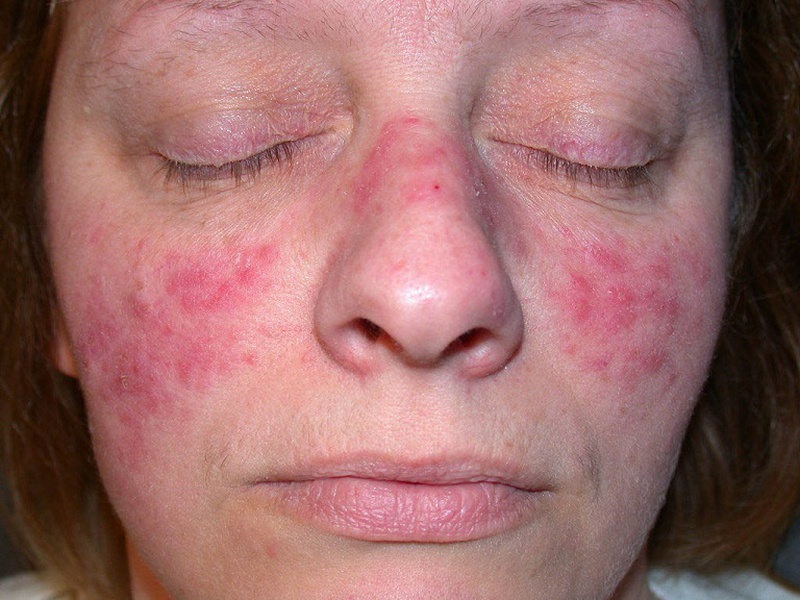 Nhận biết lupus ban đỏ ở phụ nữ và phương pháp điều trị 1