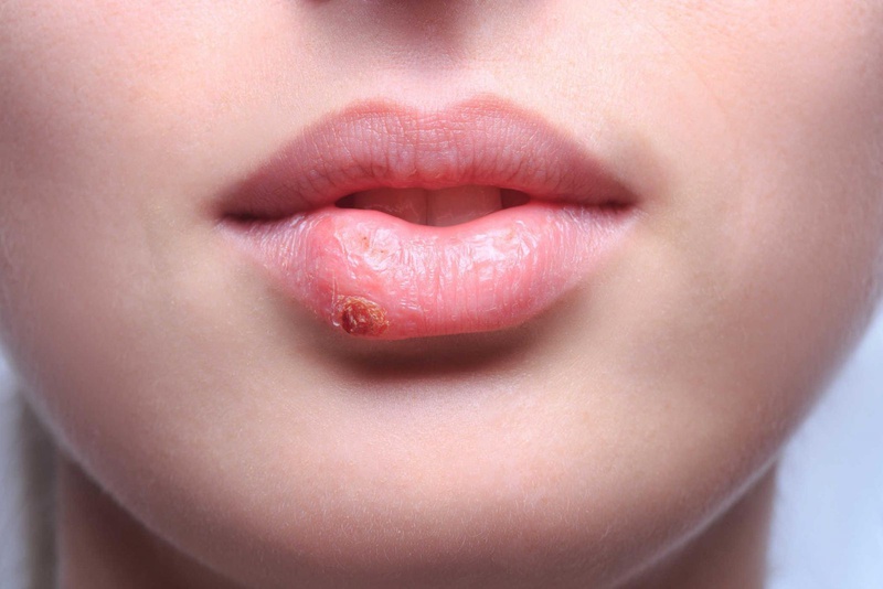 Nhận biết sớm dấu hiệu của phun môi bị nhiễm trùng - Nhà thuốc FPT ...