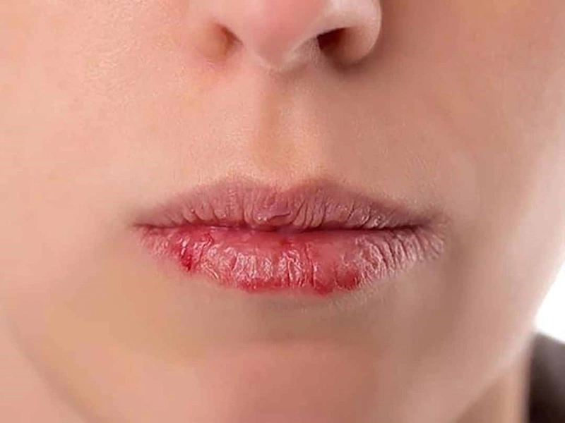 Nhận biết sớm dấu hiệu của phun môi bị nhiễm trùng  Nhà thuốc FPT Long Châu