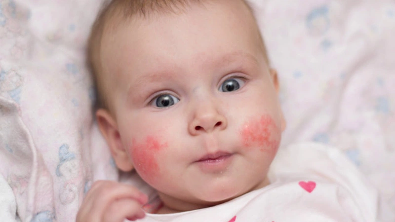 Nhận biết viêm da tiếp xúc dị ứng dị ứng ở trẻ em? 1