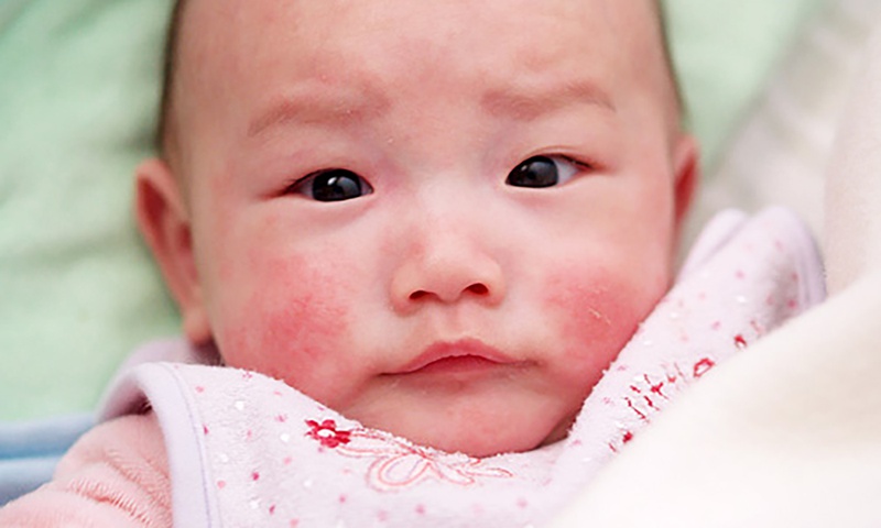 Nhận biết viêm da tiếp xúc dị ứng dị ứng ở trẻ em? 2