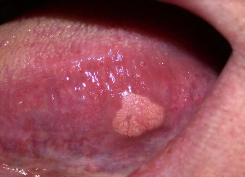 Nhận diện dấu hiệu nhiễm HPV: "Sát thủ" gây nhiều bệnh ung thư 8