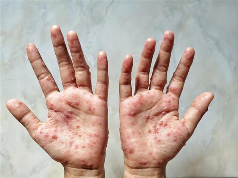Bệnh đậu mùa khỉ và những biểu hiện thường thấy 3
