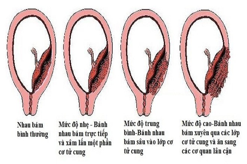 Nhau cài răng lược được chia thành 3 dạng chính dựa trên mức độ xâm lấn của nhau thai