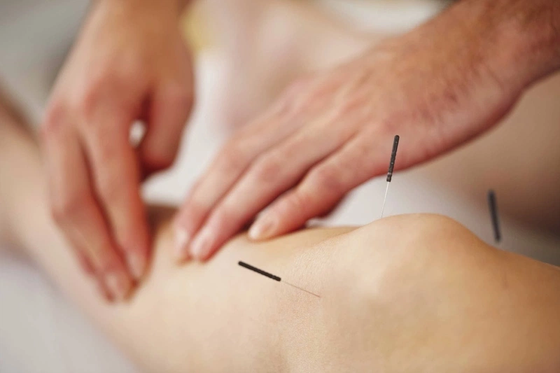 Bấm huyệt và châm cứu điều trị nhảy dây bị đau bắp chân