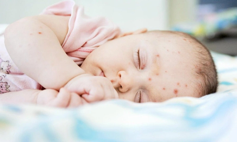 nhiễm trùng da ở trẻ sơ sinh 1