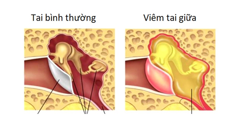 Nhiễm trùng tai cần được điều trị và phòng ngừa như thế nào? 1