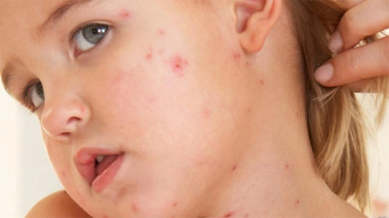 Trẻ mắc sởi từ trào lưu “anti vắc xin”: Tiêm phòng sởi không làm trẻ bị tự kỉ 2