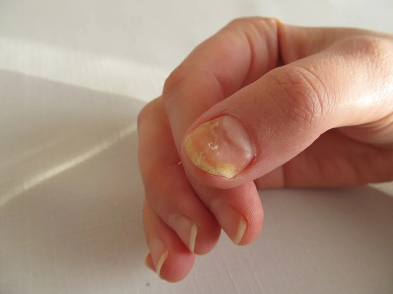 Nhìn móng tay đoán bệnh ở tim gan phổi, bạn đã biết chưa?2