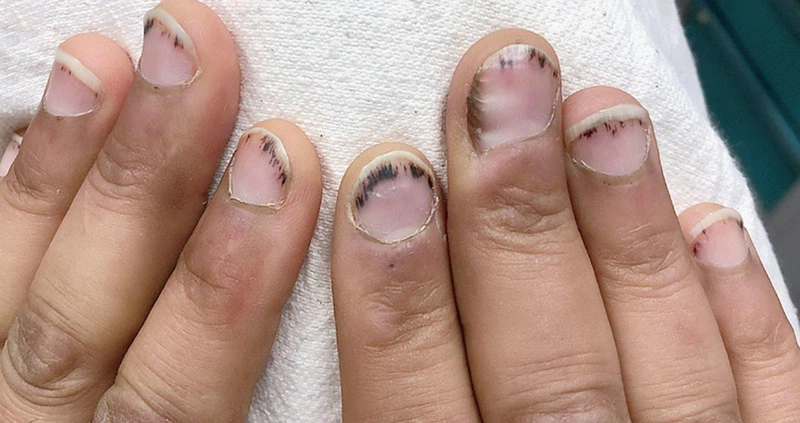 Nhìn móng tay đoán bệnh ở tim gan phổi, bạn đã biết chưa?3