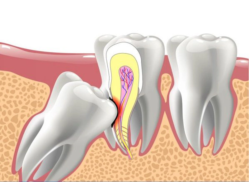 Nước muối có tính sát khuẩn cao làm cho vết thương lâu lành