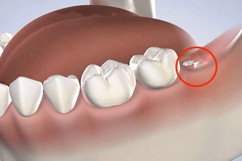 Nhổ răng khôn có mọc lại không