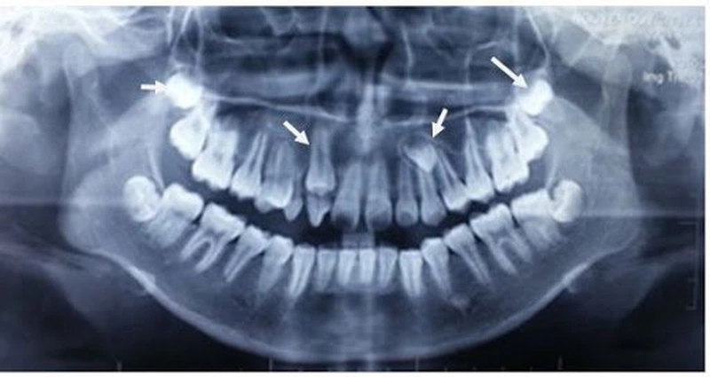 Nhổ răng mọc ngầm có nguy hiểm không, khi nào cần nhổ