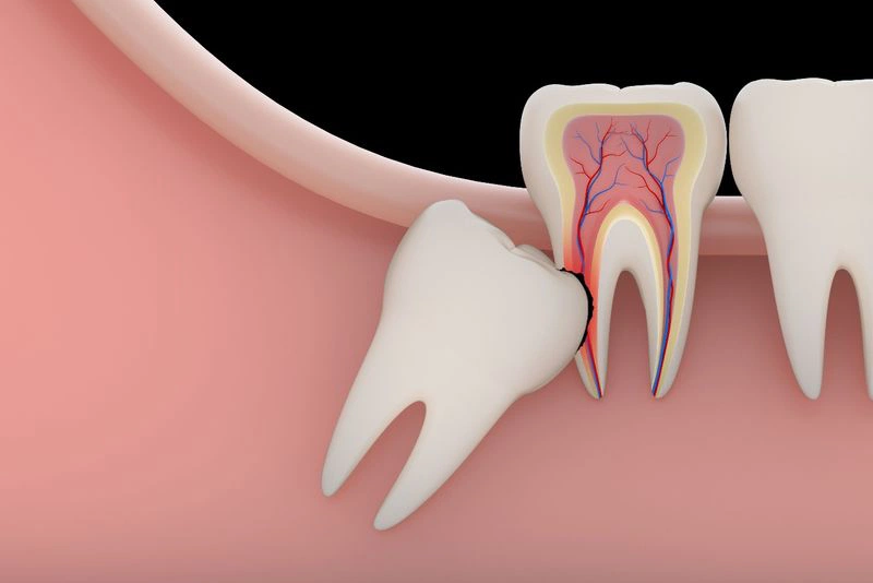 Nhổ răng mọc ngầm thường sẽ được bác sĩ nha khoa chỉ định khi răng mọc ngầm xuất hiện dấu hiệu ác tính
