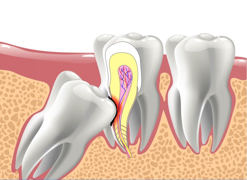 Nhổ răng vĩnh viễn có ảnh hưởng gì không