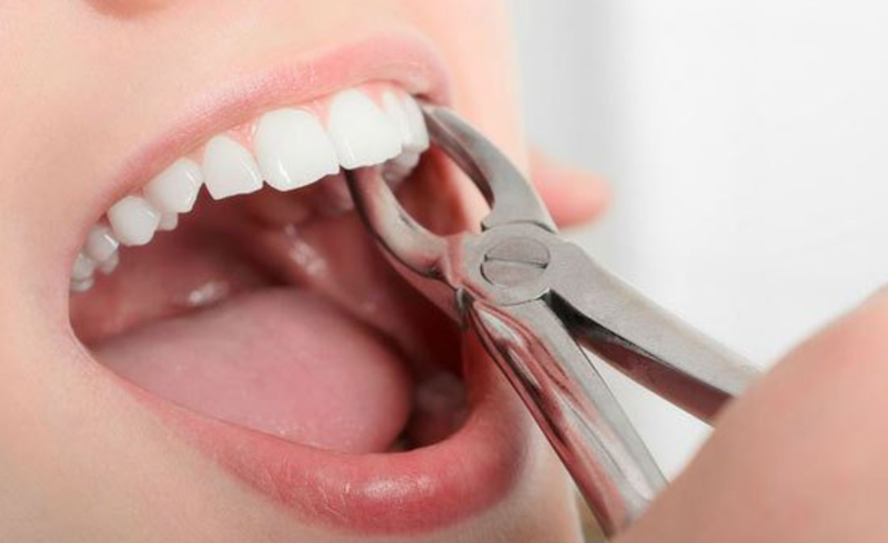 Nhổ răng vĩnh viễn có ảnh hưởng gì không, khi nào cần thiết