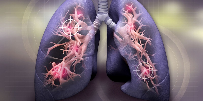 Như thế nào là ung thư phổi tái phát?1