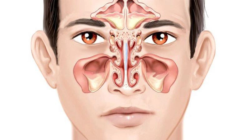 Những bài thuốc dân gian chữa viêm xoang mãn tính 1