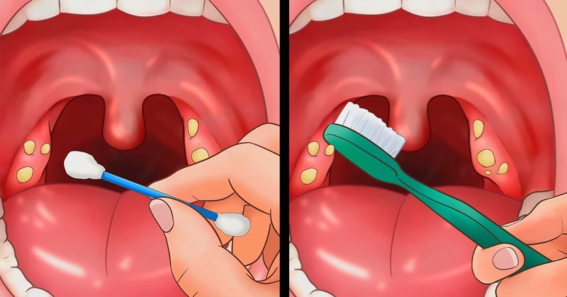 Những bệnh lý nổi hạt trong miệng thường gặp
