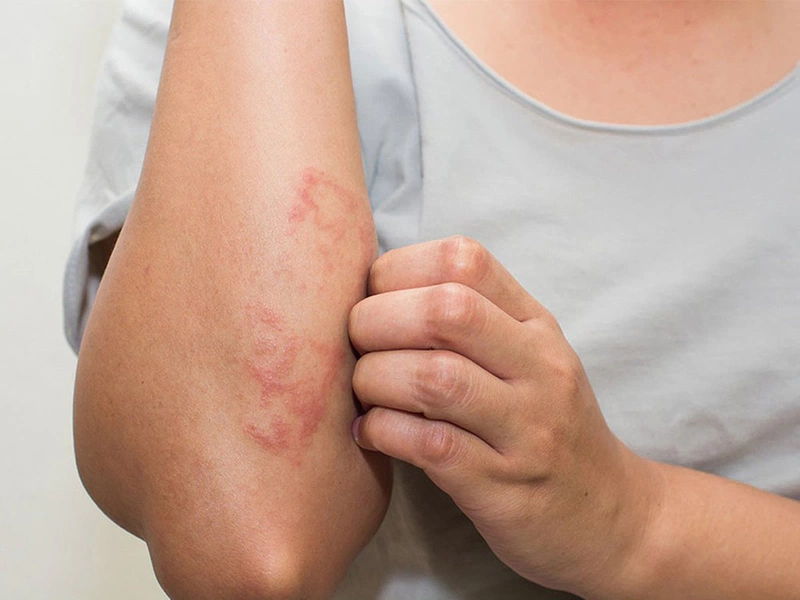 Những bệnh ngoài da hiếm gặp nhưng nguy hiểm mà bạn nên lưu ý
