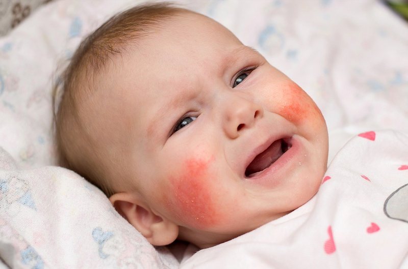 Những bí quyết chữa trị dị ứng mặt hiệu quả ai cũng cần biết 1