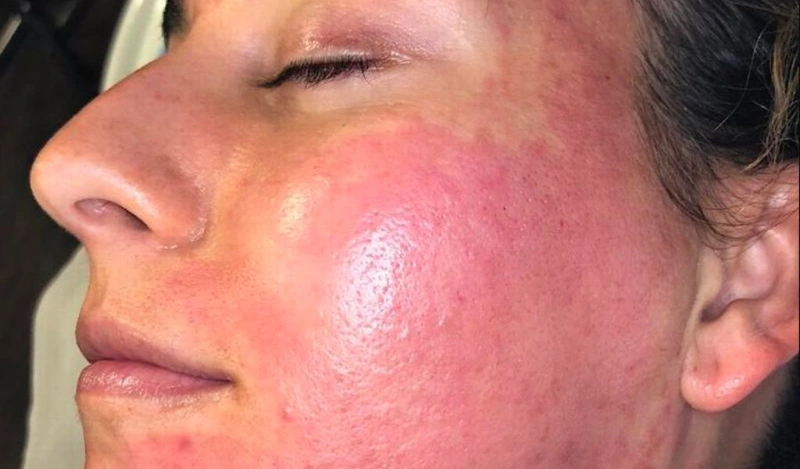 Những biến chứng của lăn kim? Nguyên nhân và cách phòng ngừa 3