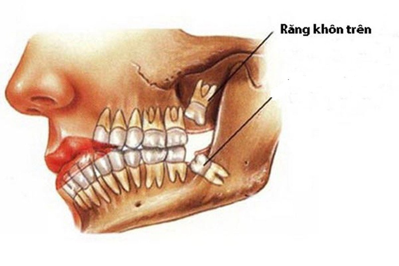 Những biến chứng khi mọc răng khôn và cách phòng tránh hiệu quả