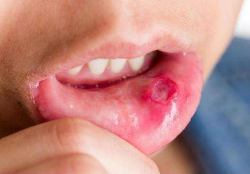 Những cách ăn uống đúng cách khi bị nhiệt miệng 1