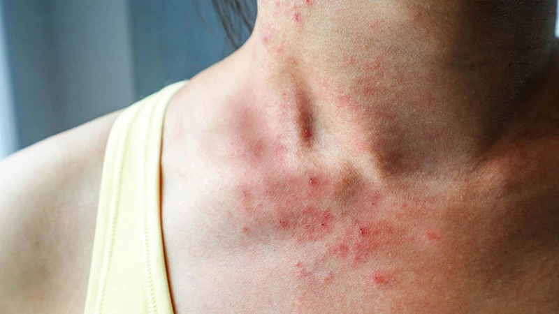 Những cách chăm sóc da cổ khỏi tình trạng mụn 1