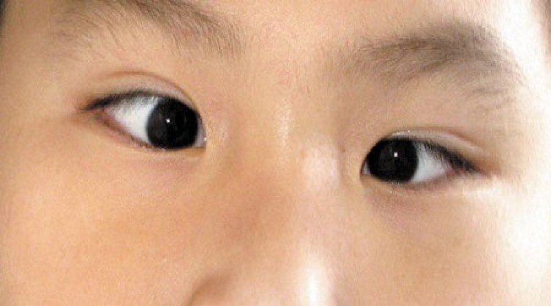 Những cách chữa trị bệnh lác mắt ở trẻ 1