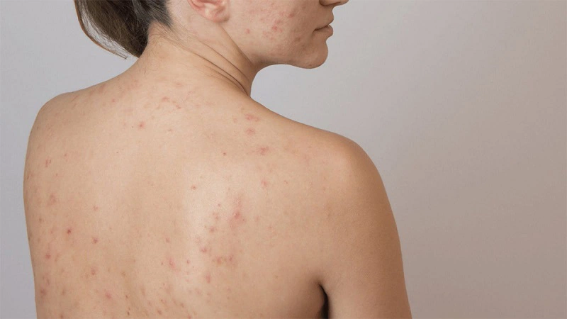 Những cách trị thâm mụn lưng tại nhà hiệu quả 1