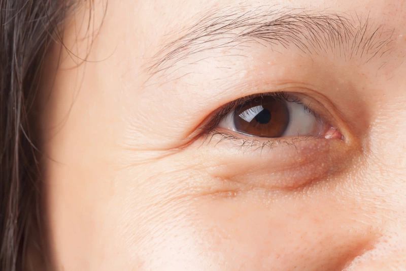 Những dấu hiệu cho thấy vùng da mắt bị lão hóa1