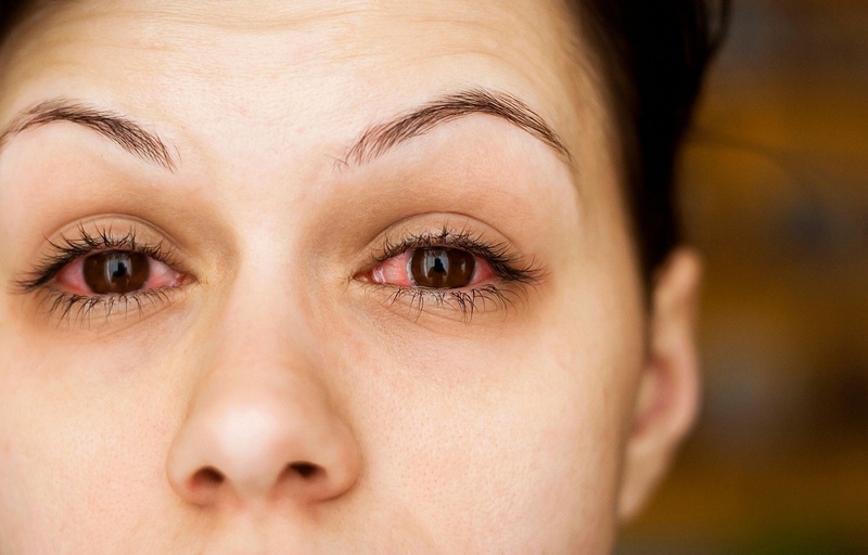 Những dấu hiệu khô mắt thường gặp mà các bạn tuyệt đối không nên chủ quan1