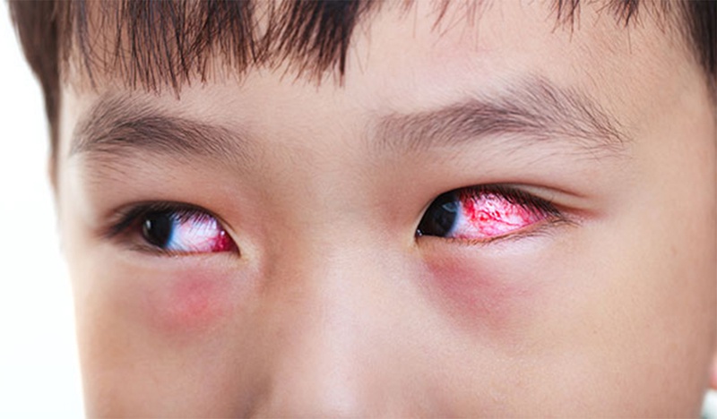 Đỏ, đau, ngứa mắt là triệu chứng của bệnh viêm kết mạc nhú gai