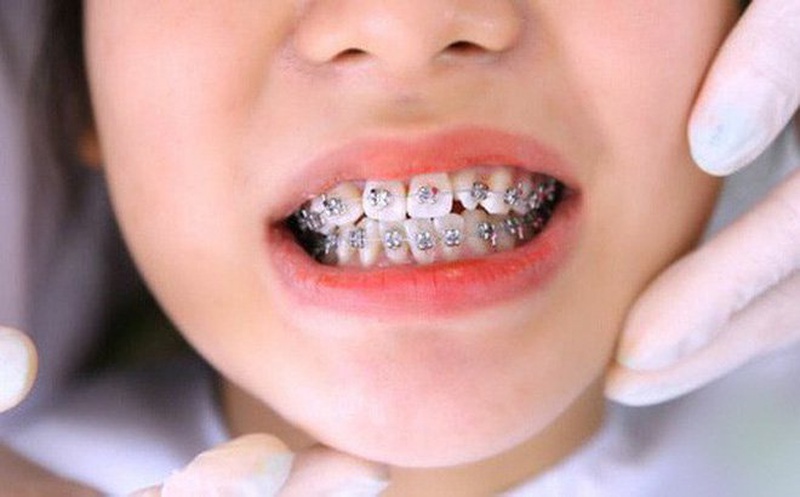 Những điều cần biết khi niềng răng ở trẻ em 4