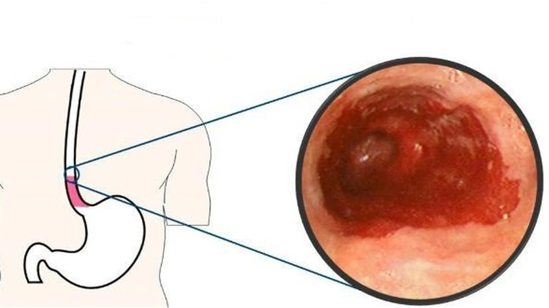 Những điều cần biết và lưu ý khi điều trị bỏng thực quản 2