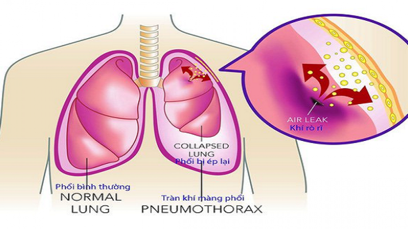 bệnh tràn khí màng phổi là bệnh gì