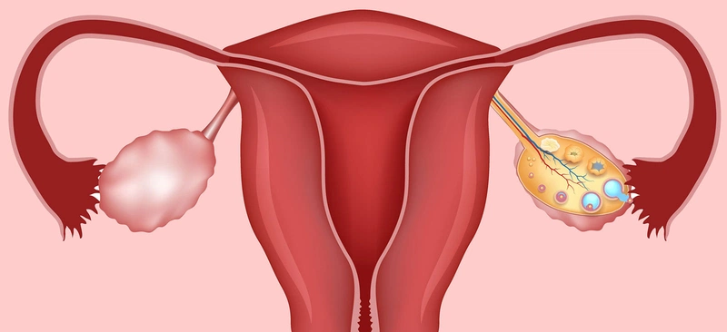 Những điều cần biết về buồng trứng đa nang ở tuổi dậy thì 1