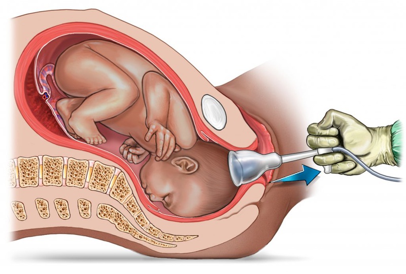 Những điều cần biết về bướu huyết thanh ở trẻ sơ sinh 1
