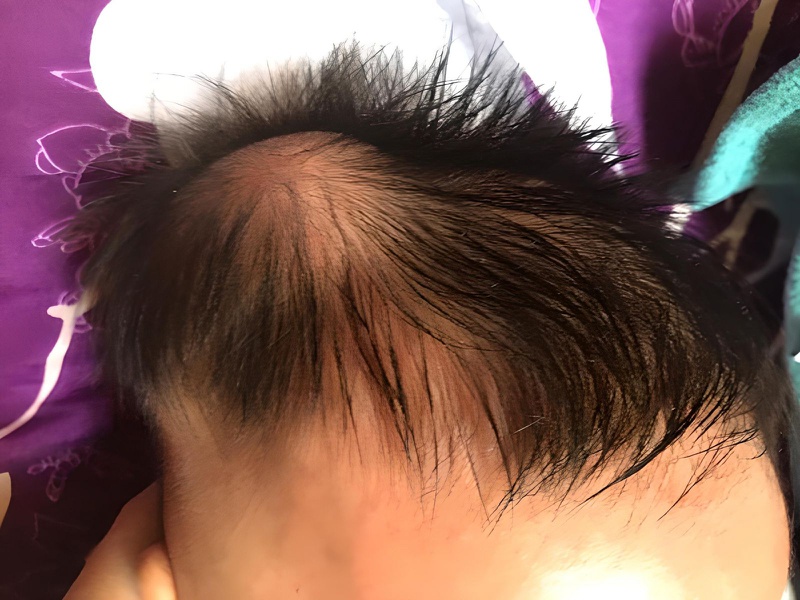 Những điều cần biết về bướu huyết thanh ở trẻ sơ sinh 2