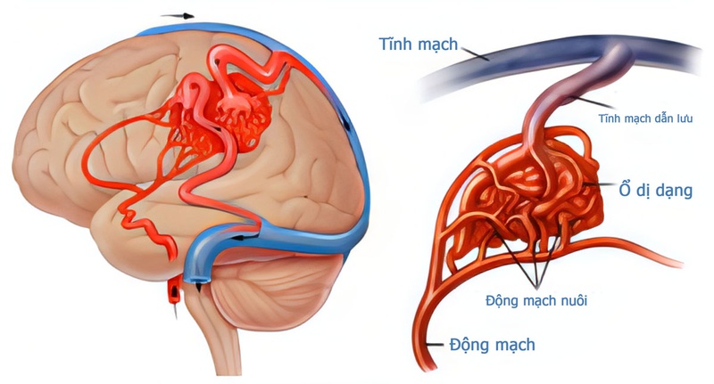 Những điều cần biết về chứng dị dạng mạch máu não