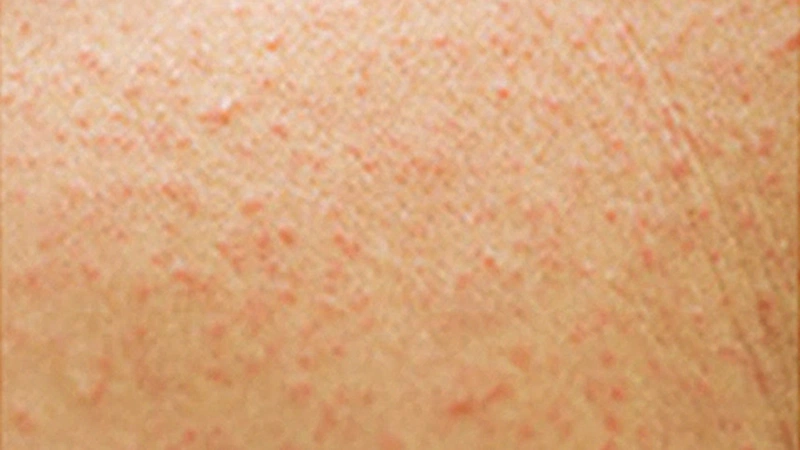 Những điều cần biết về dị ứng amoxicillin 3