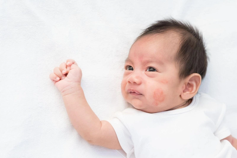 Những điều cần biết về dị ứng đạm sữa bò nhẹ ở trẻ nhỏ - Nhà thuốc FPT Long  Châu