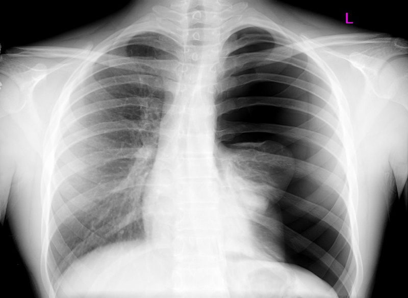 Bệnh nhân có nguy cơ bị tràn khí màng phổi khi nội soi phế quản sinh thiết