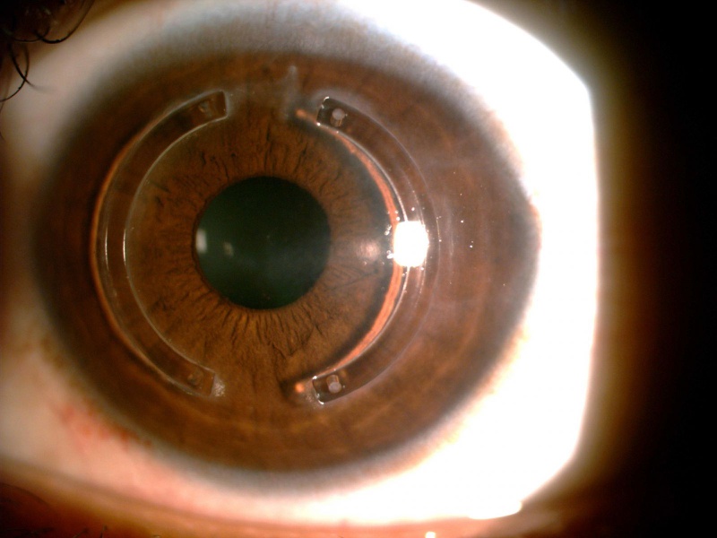 Những điều cần biết về phẫu thuật mắt cận 4